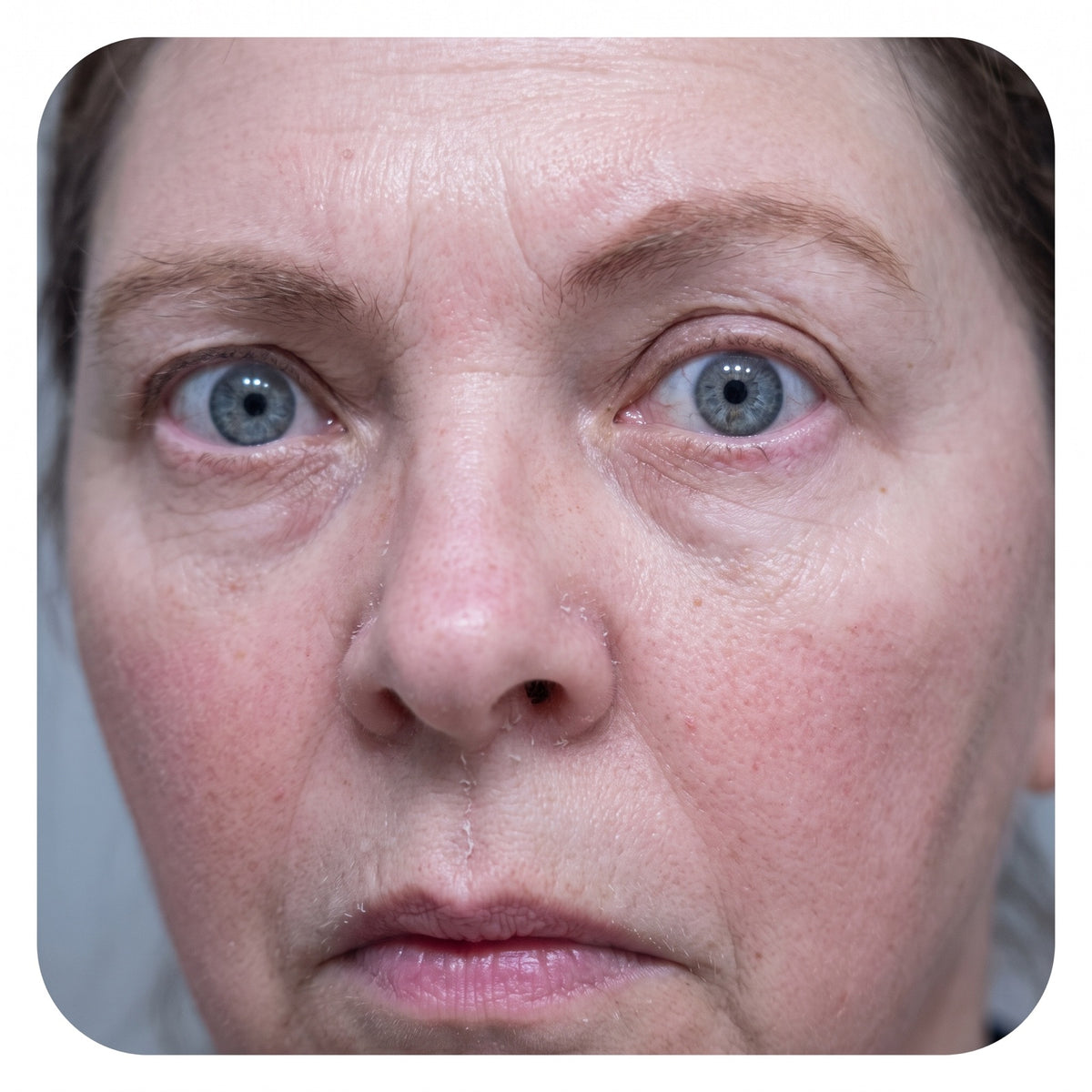 Close, honest photo of a woman's cheek and the side of her nose showing the classic over-exfoliated look: tight, shiny,