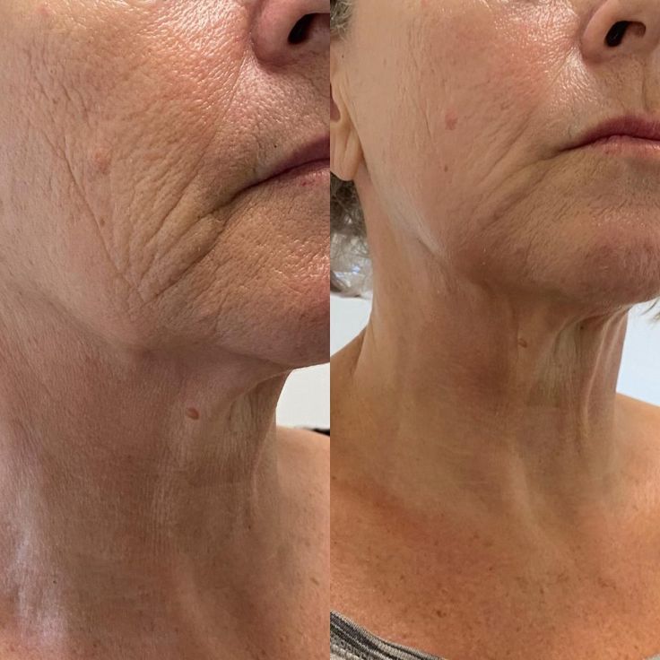 Before and after photo of a customer's neck and jawline, before on the left and after on the right